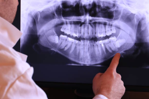Best Emergency Tooth Extraction in Germantown Hls, IL