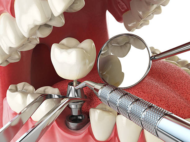 Best Emergency Wisdom Teeth Removal in Germantown Hls, IL